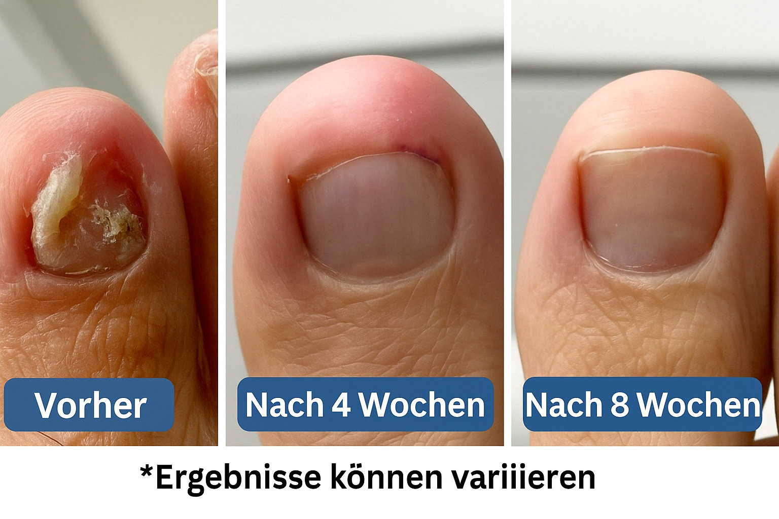Fall #1: 7 Jahre Nagelpilz – in 8 Wochen verschwunden