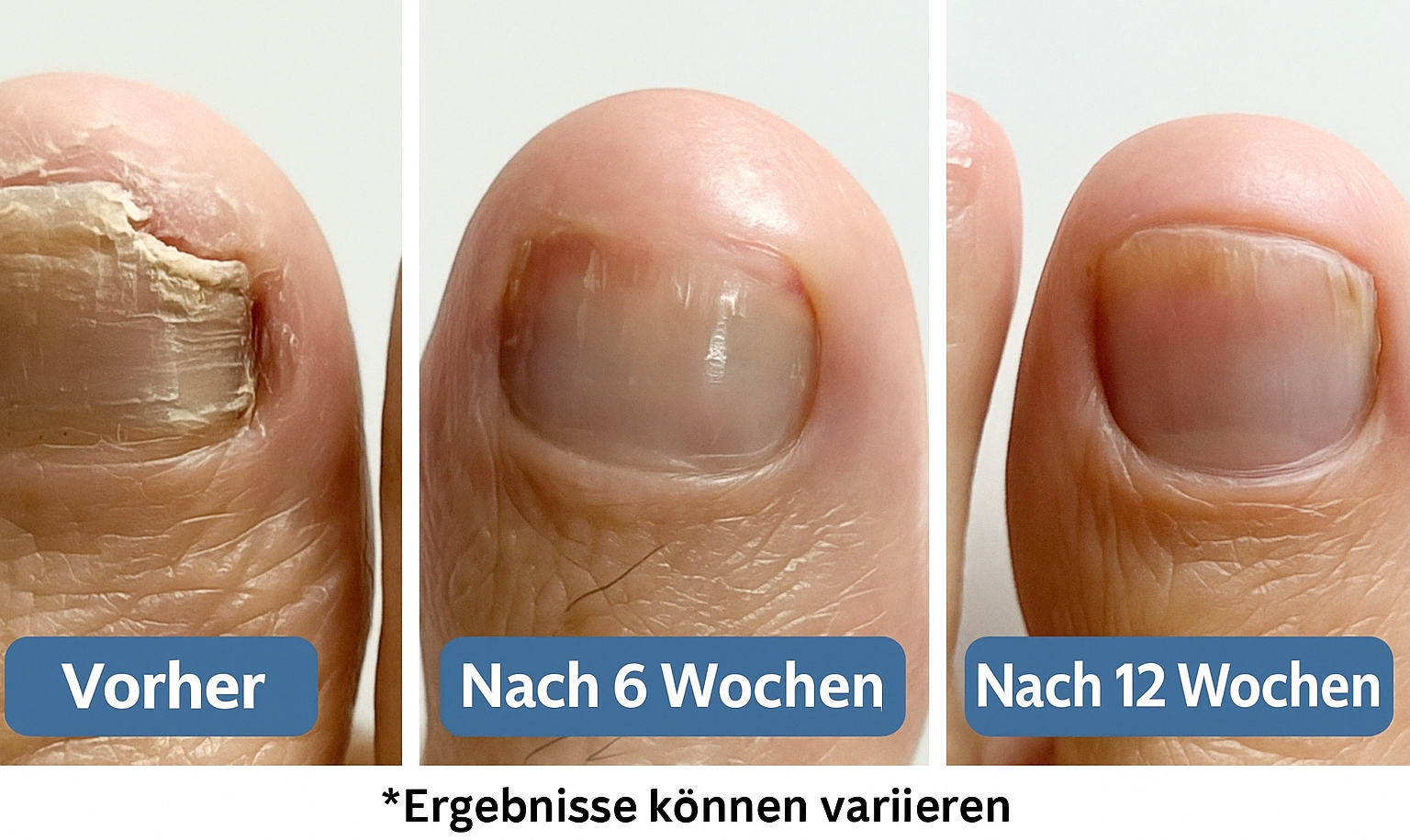 Fall #2: 62-Jährige sagt OP ab – und besiegt Nagelpilz in nur 5 Wochen