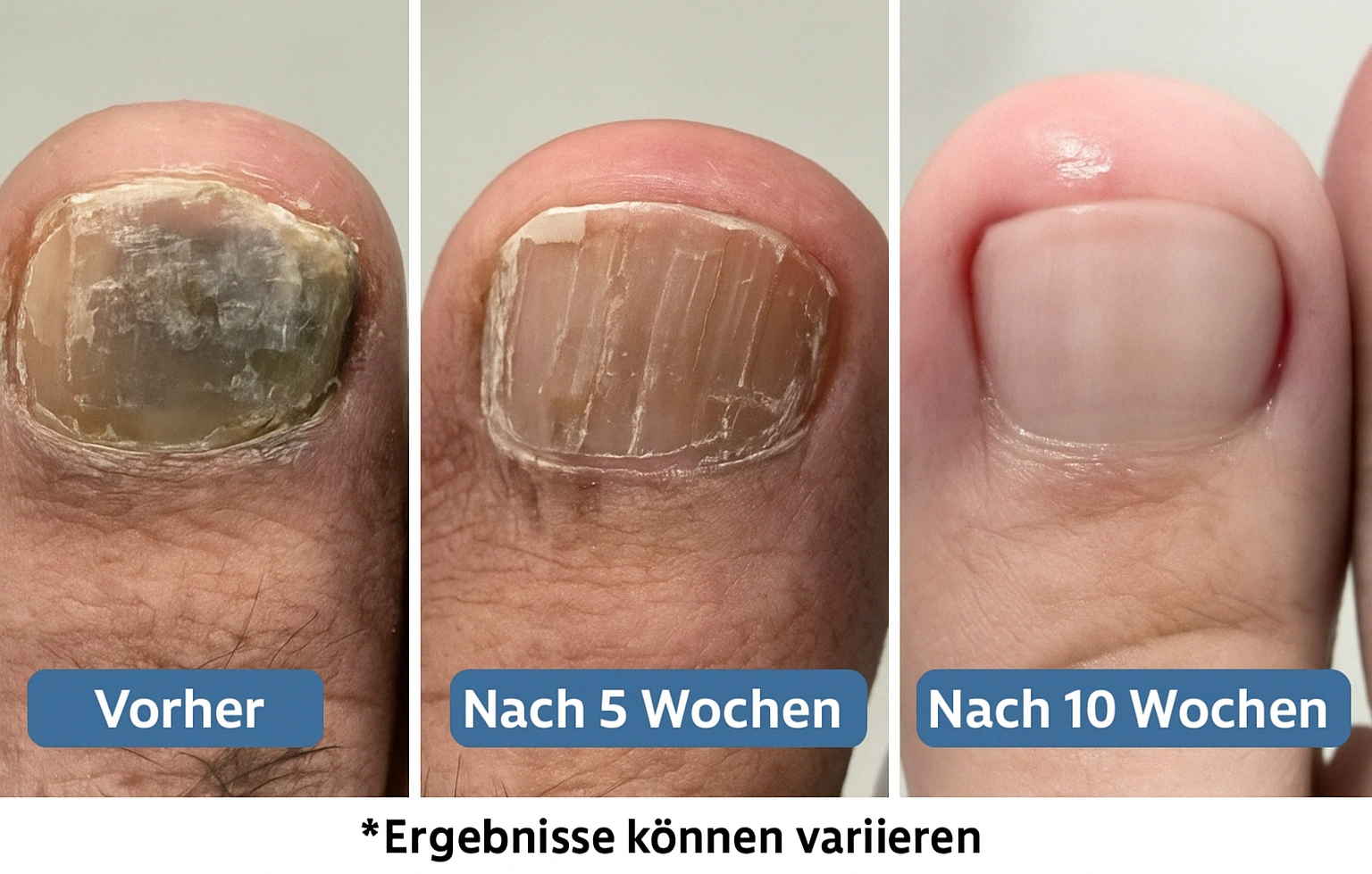 Fall #3: Sportler durch Nagelpilz ausgebremst – nach 10 Wochen wieder am Laufen