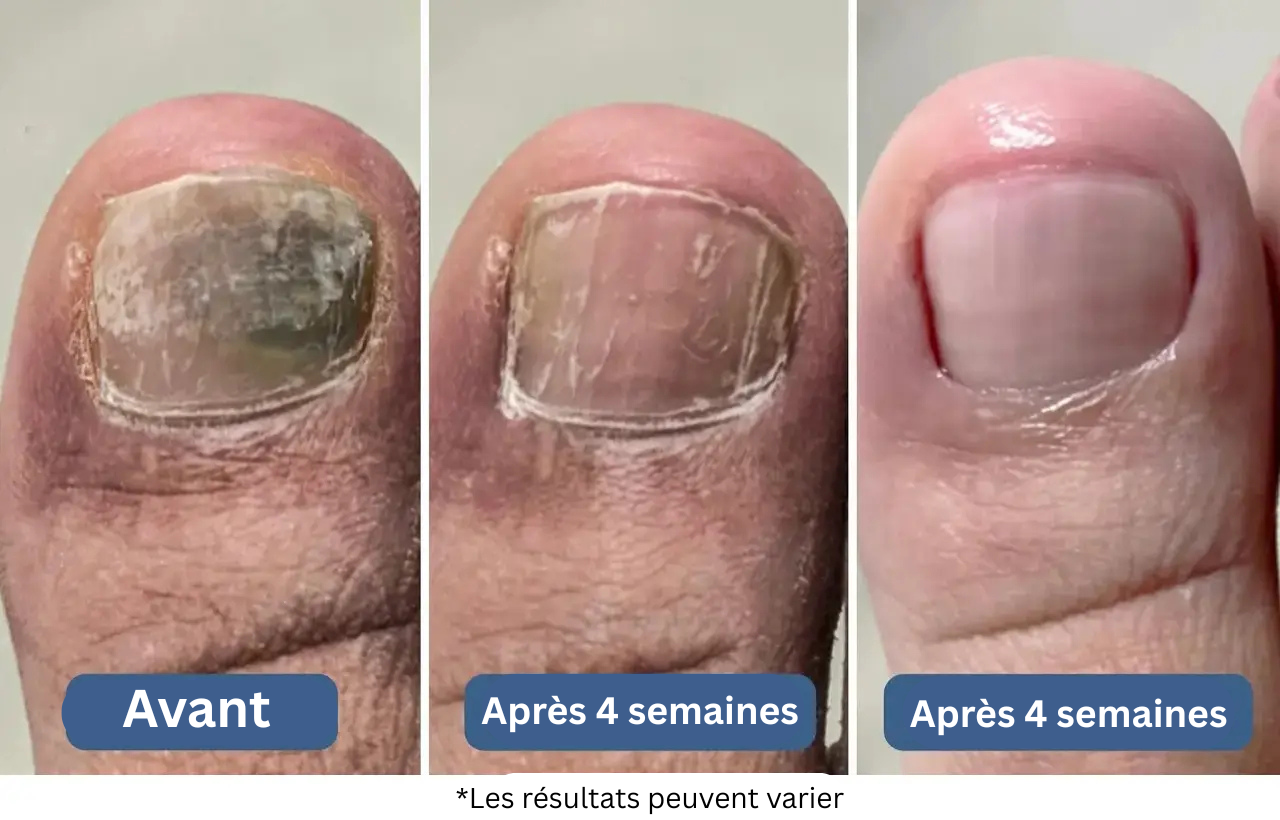 Cas n°3 : Un sportif paralysé par une mycose des ongles court à nouveau après 10 semaines
