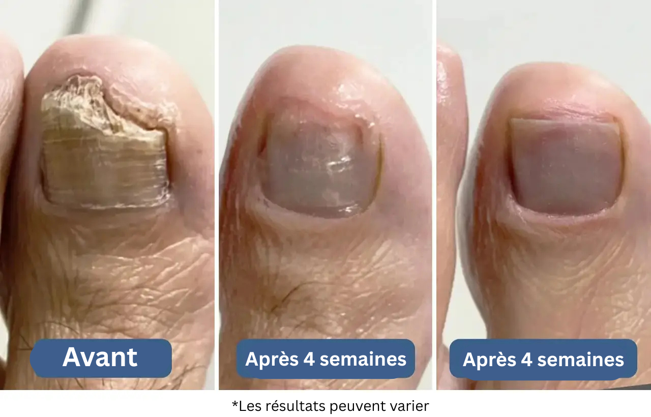 Cas n°2 : Une femme de 62 ans annule son opération et élimine la mycose en 5 semaines